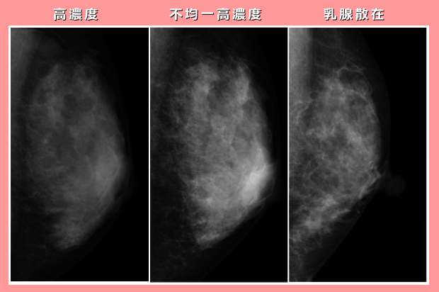 しこり の ない 乳癌 ブログ