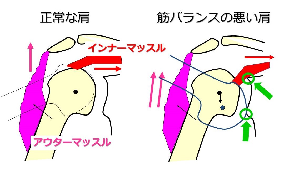 肩 が ピキッ と なる