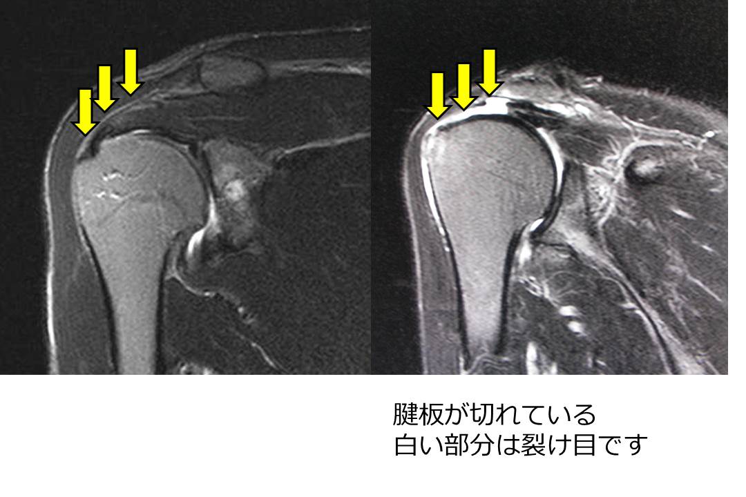 断裂 腱 板 肩腱板（かたけんばん）断裂の診断と治療｜24時間救急指定病院・小林病院