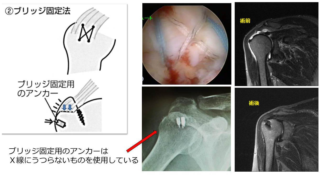 腱 板 損傷