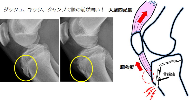 手術 ジャンパー 膝